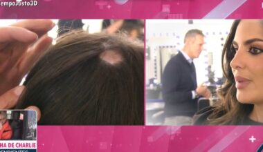 Alopecia areata, la enfermedad que está provocando calvas de pelo a Alexia Rivas: «Me daba vergüenza mostrarlo»