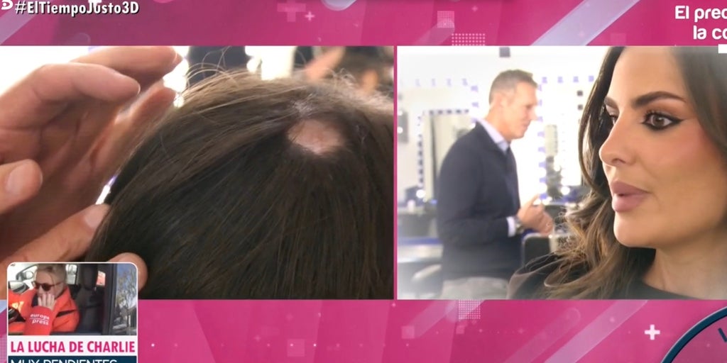 Alopecia areata, la enfermedad que está provocando calvas de pelo a Alexia Rivas: «Me daba vergüenza mostrarlo»