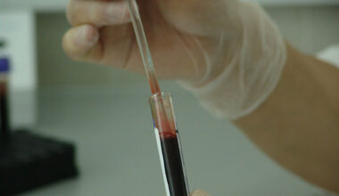 Un paciente con leucemia y VIH permanece m&aacute;s de seis a&ntilde;os sin rebote viral tras un trasplante de c&eacute;lulas madre