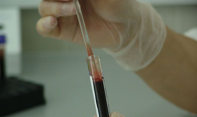 Un paciente con leucemia y VIH permanece m&aacute;s de seis a&ntilde;os sin rebote viral tras un trasplante de c&eacute;lulas madre