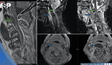 Infección oral avanza a absceso cervical con compromiso epidural y shock séptico en adulto mayor