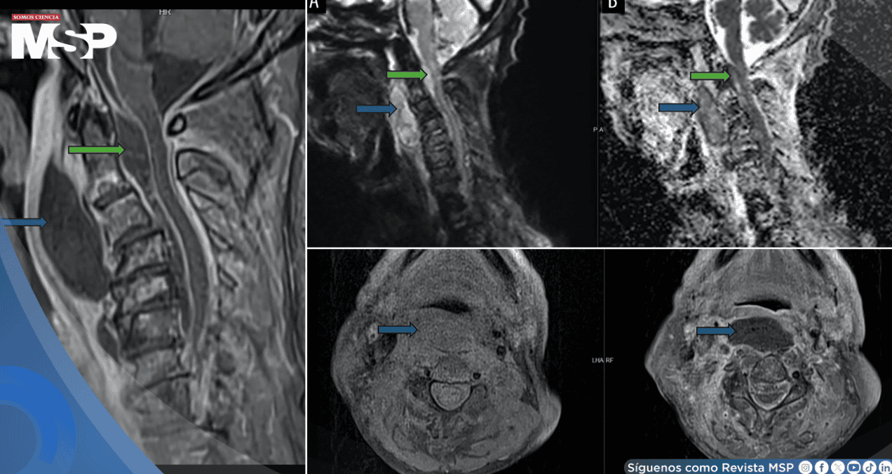 Infección oral avanza a absceso cervical con compromiso epidural y shock séptico en adulto mayor