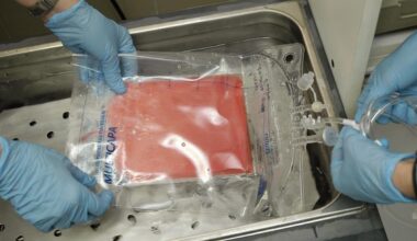 Consiguen eliminar el VIH de un paciente de leucemia con un trasplante de células madre