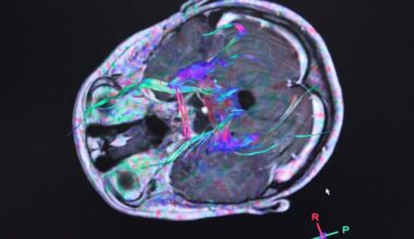 Hallan un patrón en enfermedades de cerebro e intestino que mejoraría la detección del Párkinson