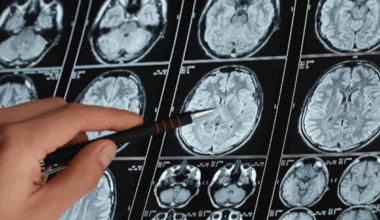 Identifican un mecanismo molecular común entre el párkinson la depresión y la inflamación intestinal