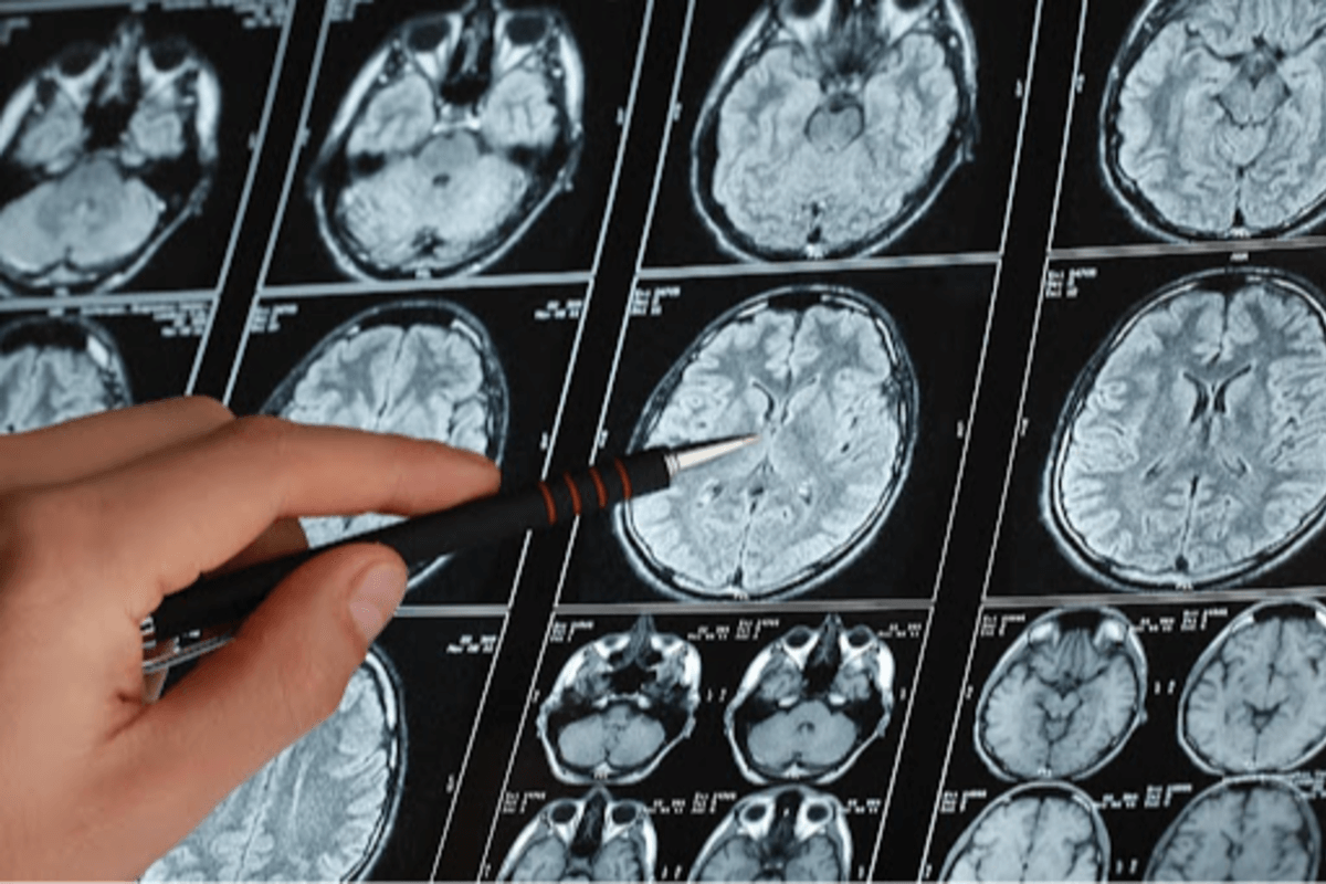 Identifican un mecanismo molecular común entre el párkinson la depresión y la inflamación intestinal