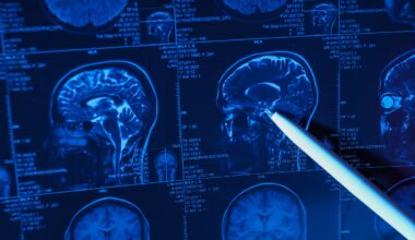 Un derivado de la curcumina ofrece protección en un modelo de ictus