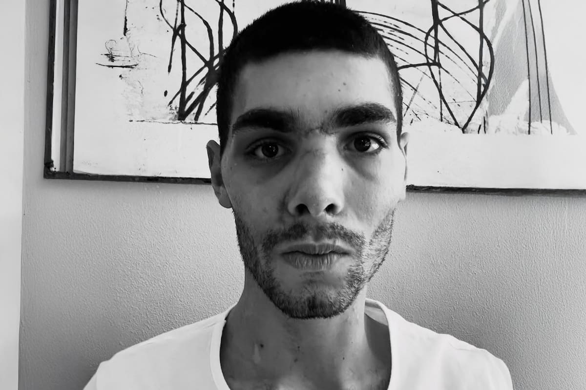 El ciclista italiano que pasó dos semanas en coma y atravesó una reconstrucción facial