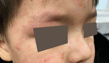 Niño con sarampión