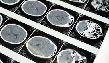 El hallazgo de un patr&oacute;n molecular en enfermedades del cerebro y el intestino abre la v&iacute;a para mejorar la detecci&oacute;n del p&aacute;rkinson