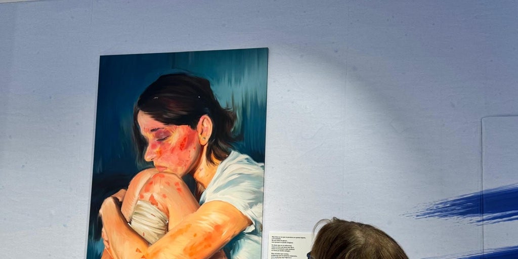 una exposición que muestra la dermatitis atópica grave