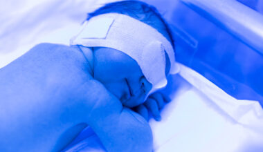 Mejorando los tratamientos de luz azul para tratar la ictericia neonatal