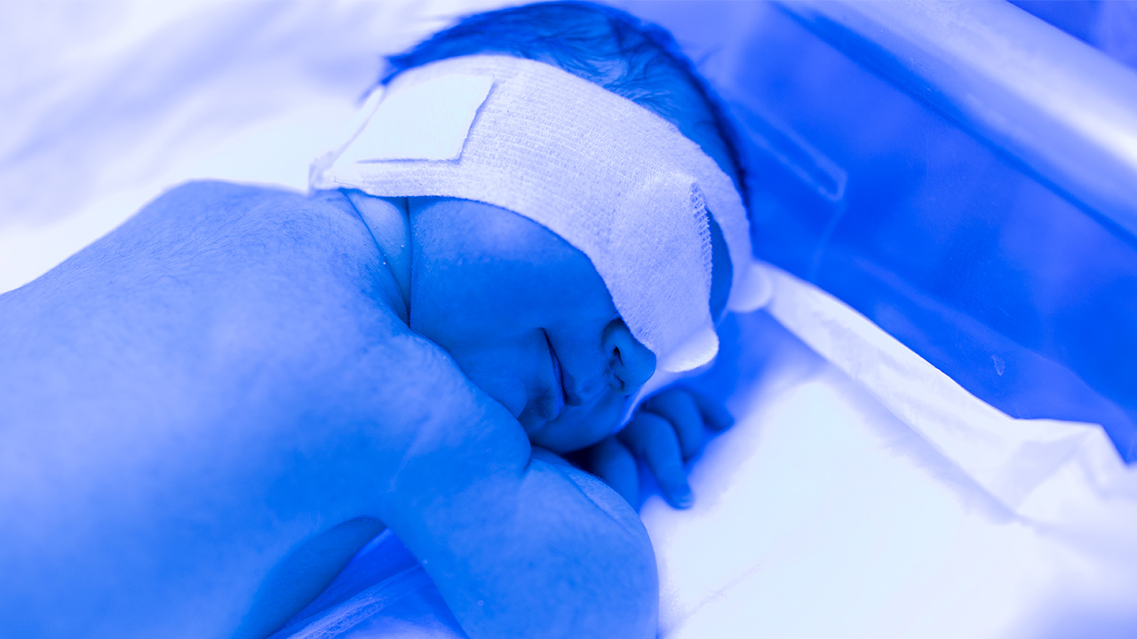 Mejorando los tratamientos de luz azul para tratar la ictericia neonatal