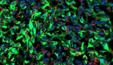 1. Cancer_Astrocyte_Interaction_Brain_Tumor