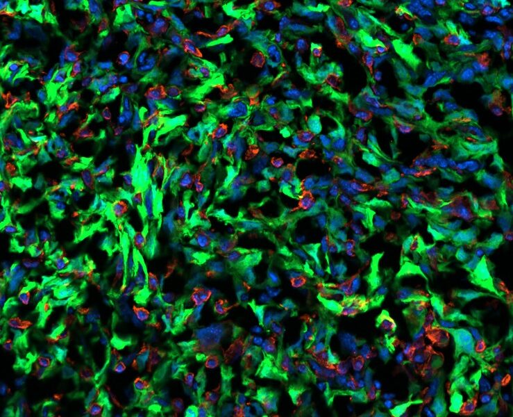 1. Cancer_Astrocyte_Interaction_Brain_Tumor