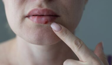 Cómo actúan los nuevos medicamentos que frenan la replicación del virus del herpes, según un estudio de Harvard