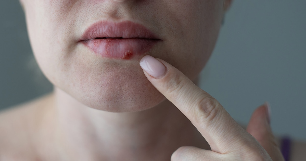 Cómo actúan los nuevos medicamentos que frenan la replicación del virus del herpes, según un estudio de Harvard