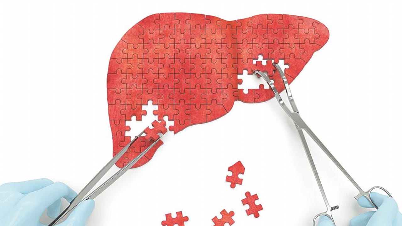 Alertan del preocupante riesgo de desarrollar cáncer por tratar de controlar el hígado graso