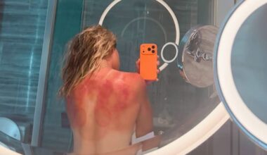 Zarazúa muestra las quemaduras del sol de Australia: “No es una broma”