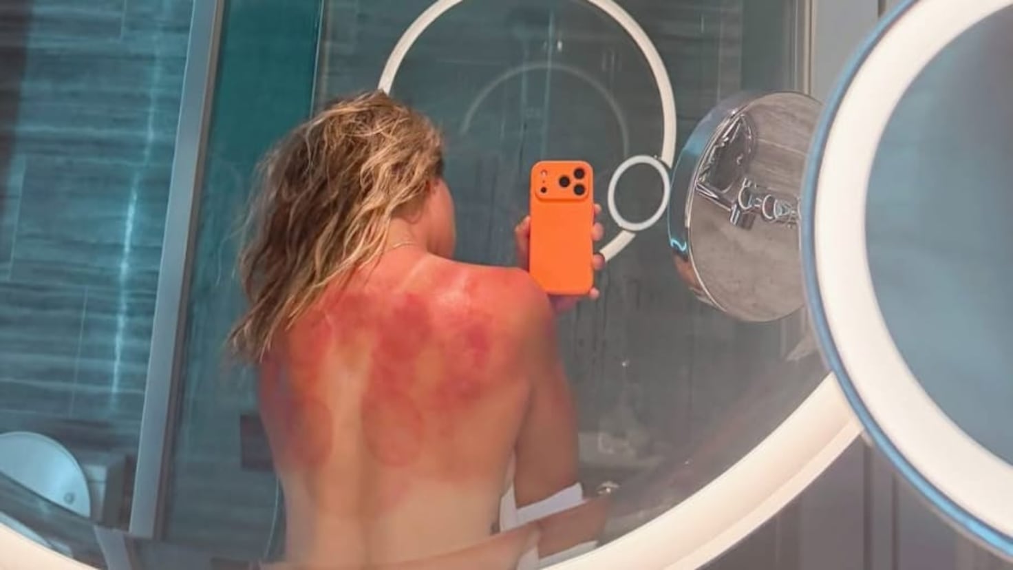 Zarazúa muestra las quemaduras del sol de Australia: “No es una broma”