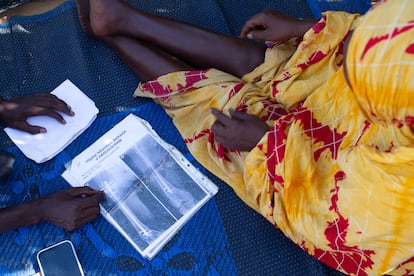 Khadija Haroun muestra las radiografías de su pierna, donde se distinguen siete clavos y una barra metálica que debían habérsele retirado hace seis meses, en su casa del campo de refugiados de Farchana, en el este de Chad, en diciembre de 2025.