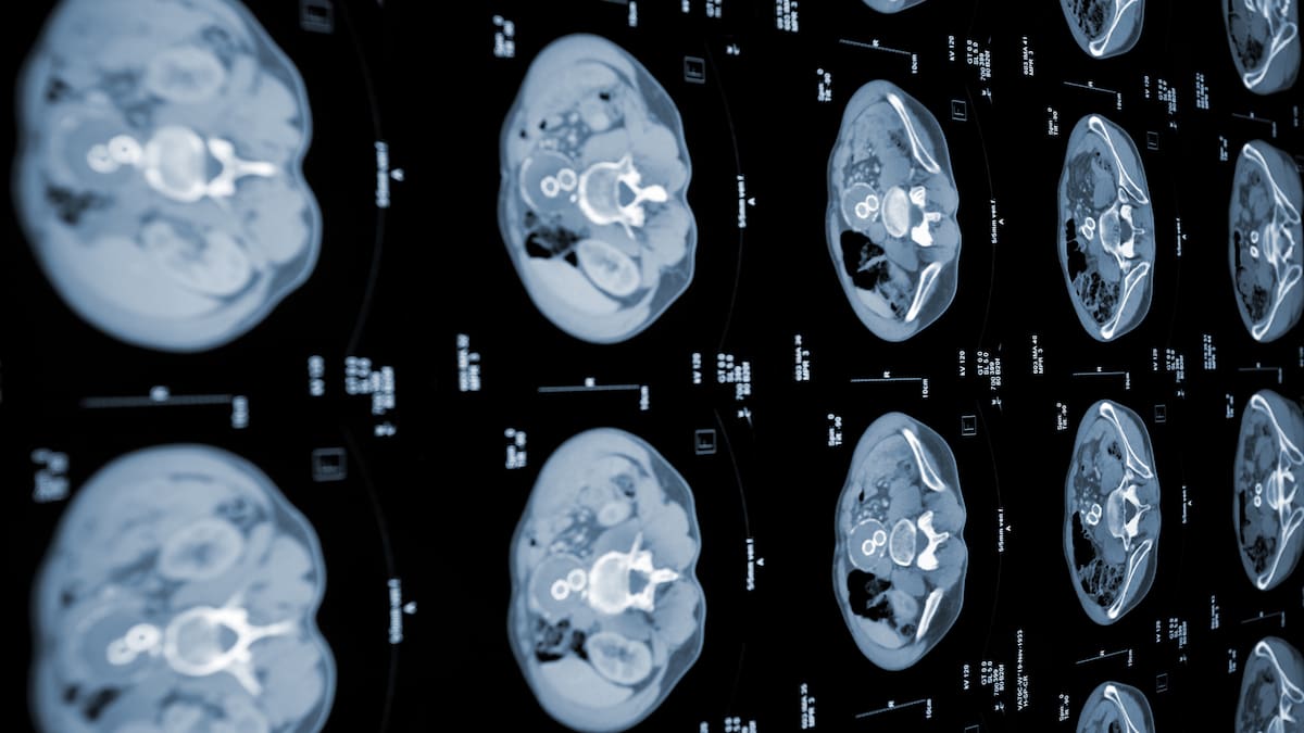 PANDA: una IA china que detecta cáncer de páncreas sin usar contraste | Ciencia y tecnología