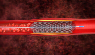 El stent carotídeo reduce a la mitad el riesgo de ictus en pacientes asintomáticos con estenosis grave