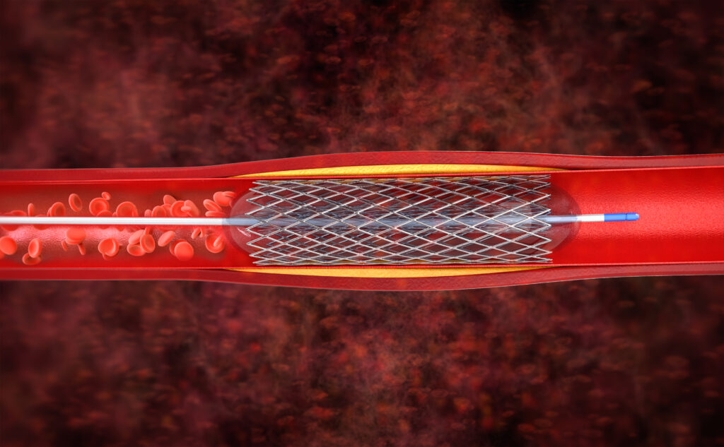El stent carotídeo reduce a la mitad el riesgo de ictus en pacientes asintomáticos con estenosis grave