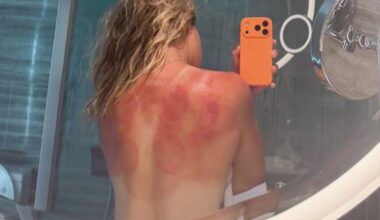 Una tenista desnuda su espalda quemada para alertar del peligro del sol en Australia