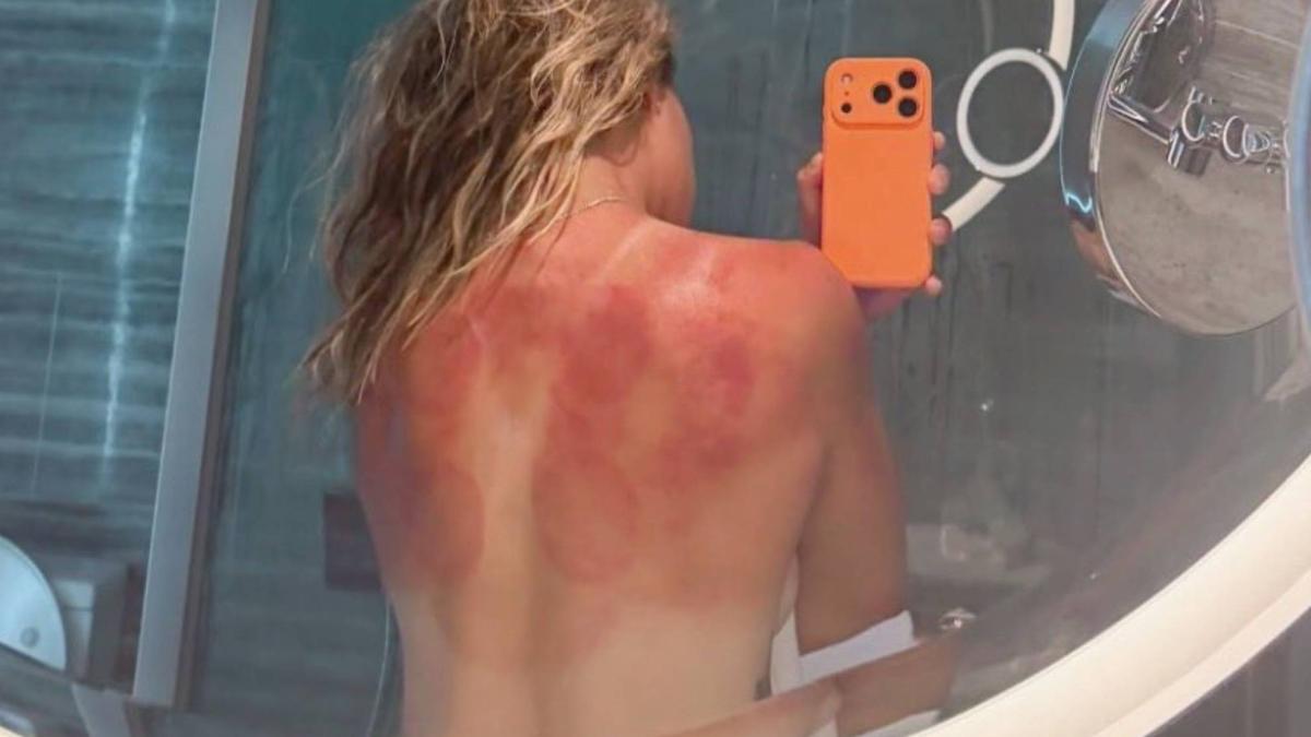 Una tenista desnuda su espalda quemada para alertar del peligro del sol en Australia