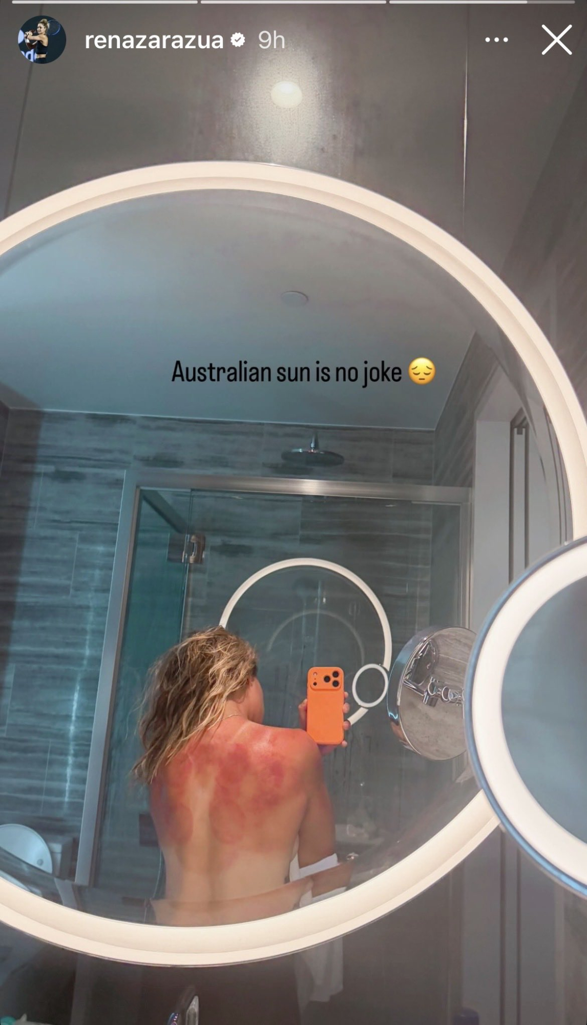 La tenista Renata Zarazúa desnuda su espalda quemada para alertar del peligro del sol en Australia
