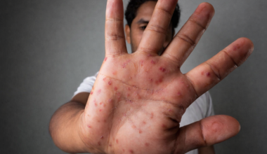 Alerta por exposición a sarampión en restaurante de Gastonia