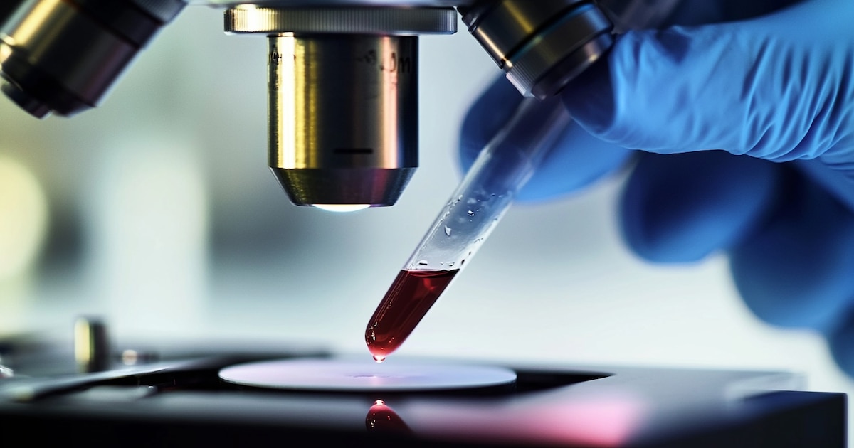 Alzheimer: un método experimental logró detectar la enfermedad a partir de una gota de sangre