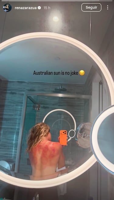 Zarazúa muestra las quemaduras del sol de Australia: “No es una broma”