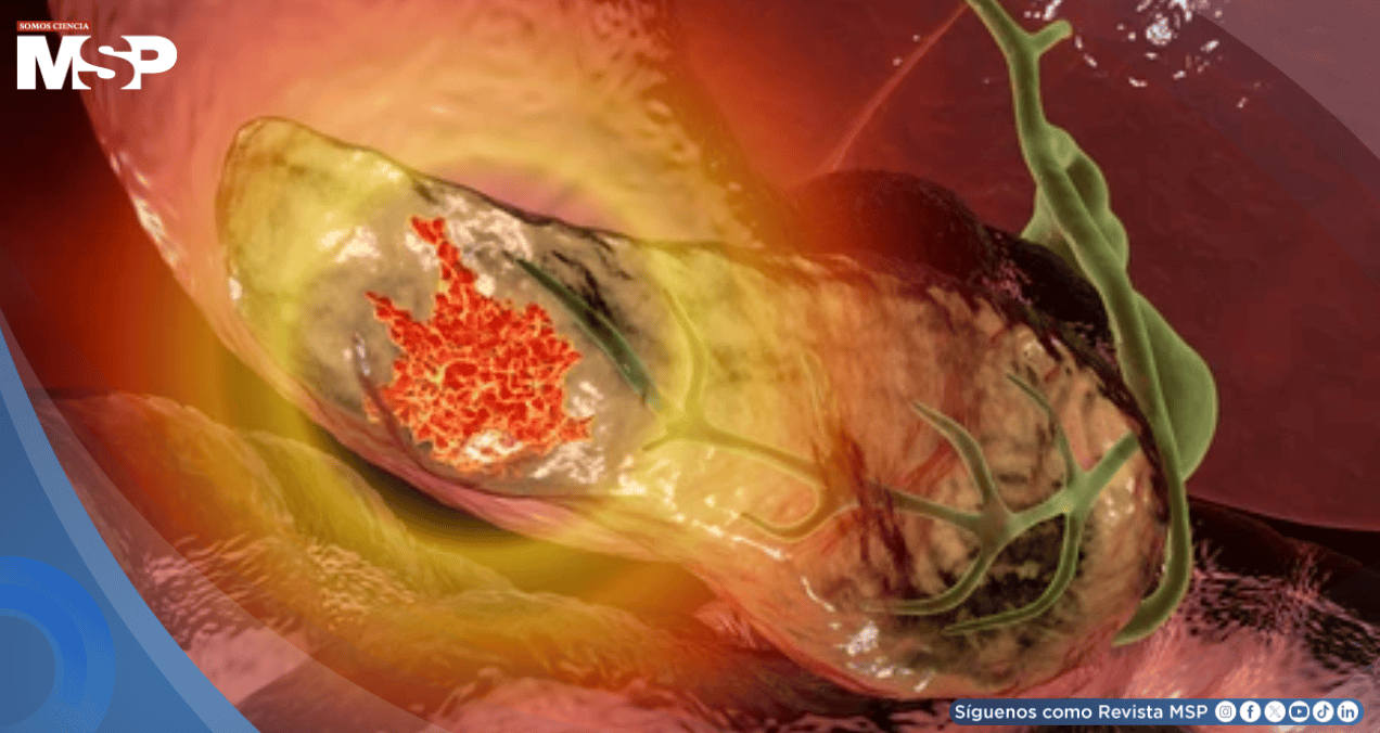Identifican genes que aumentan el riesgo de cáncer de páncreas y permiten detectar población susceptible