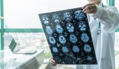 Identifican las células de origen de un tumor cerebral común en adultos jóvenes