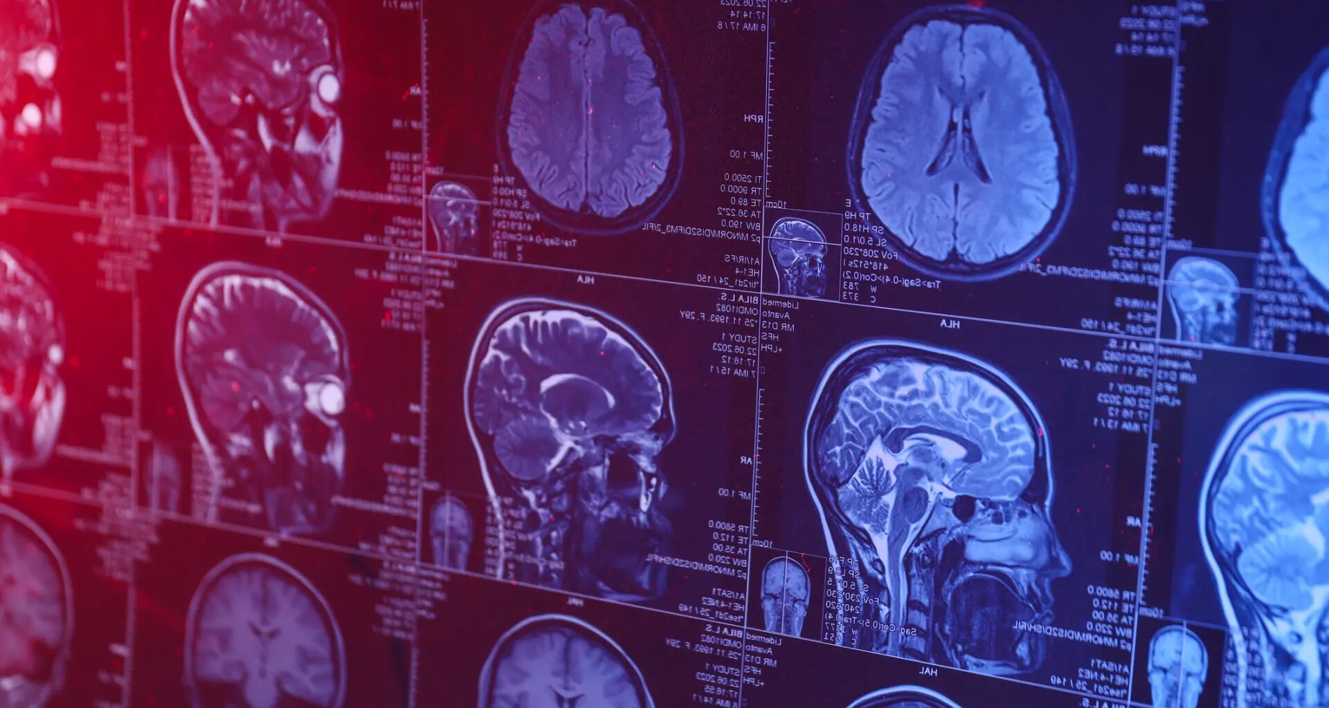 Un adolescente chino de 19 años se convierte en la persona más joven de la historia diagnosticada con alzhéimer