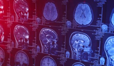 Un adolescente chino de 19 años se convierte en la persona más joven de la historia diagnosticada con alzhéimer