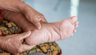 Hallan una variedad oculta de E coli involucrada en infecciones del pie diabético