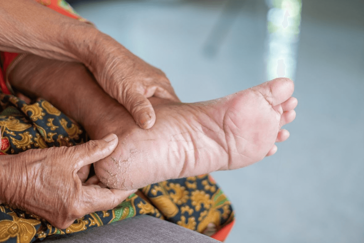 Hallan una variedad oculta de E coli involucrada en infecciones del pie diabético