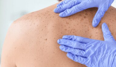 Los organoides tumorales predicen la respuesta a la inmunoterapia en el melanoma metastásico