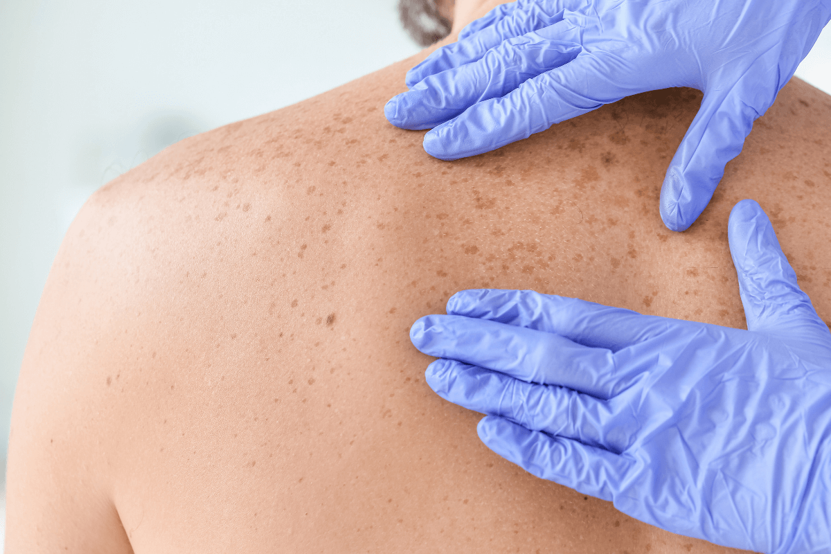 Los organoides tumorales predicen la respuesta a la inmunoterapia en el melanoma metastásico