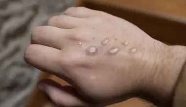 La viruela del mono evoluciona de forma inesperada tras la emergencia internacional y en Baleares confirman el primer caso