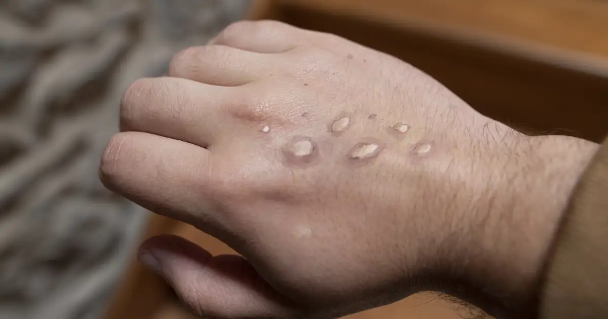 La viruela del mono evoluciona de forma inesperada tras la emergencia internacional y en Baleares confirman el primer caso