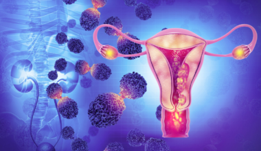 El gluconato sódico reduce la progresión del cáncer de ovario en un modelo animal