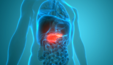 Identifican una nueva diana terapéutica y factor pronóstico en el cáncer de páncreas