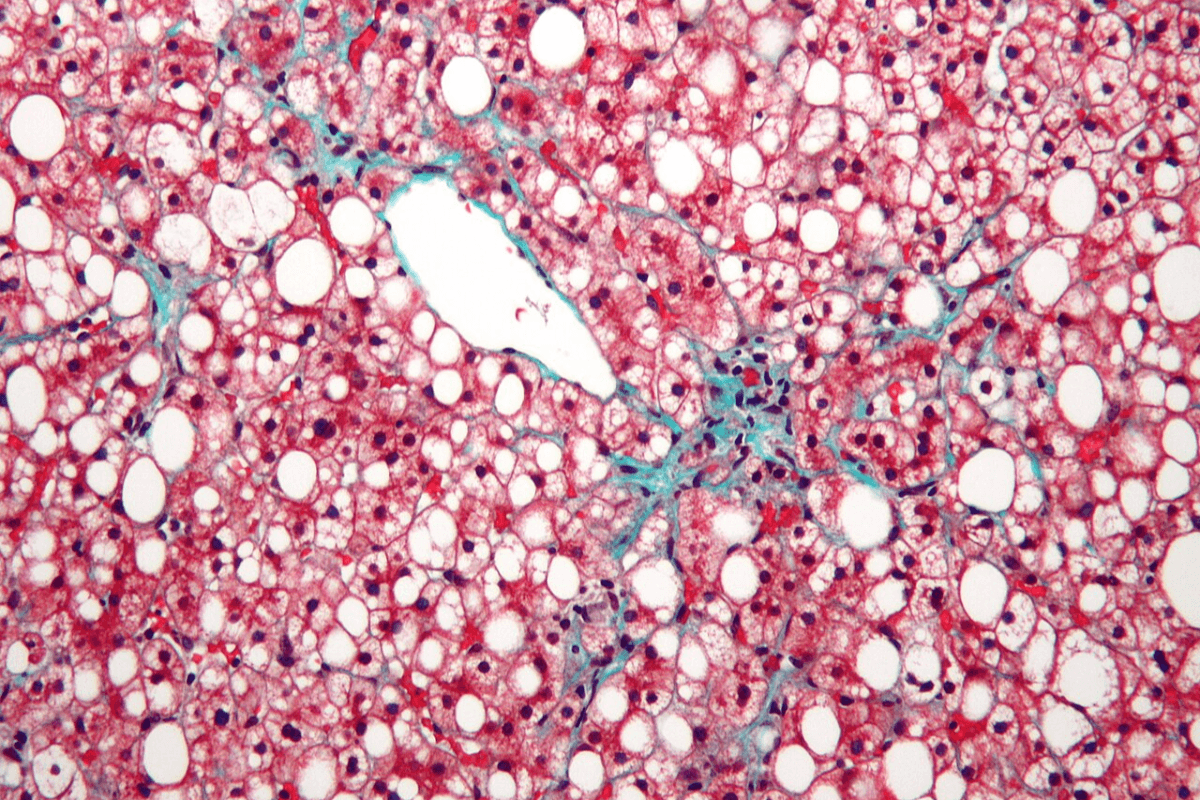 Un fármaco experimental reduce la fibrogénesis en modelos de esteatosis hepática