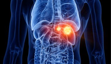 Una nanoterapia reactiva la inmunidad antitumoral en un modelo de cáncer hepático