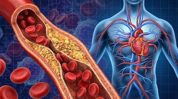 Ilustración médica de una arteria con placa obstructiva y glóbulos rojos, junto a la anatomía del sistema cardiovascular humano.