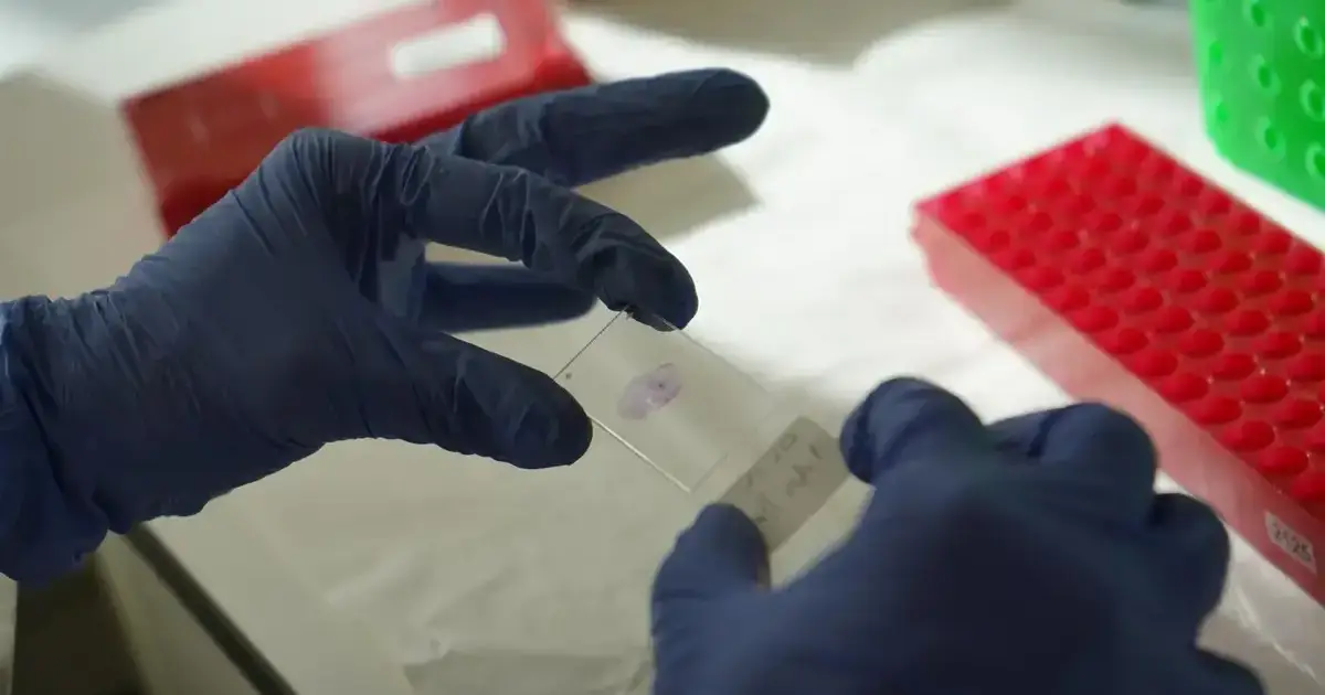 El Vhir de Barcelona desarrollará un tratamiento tópico contra el lupus eritematoso discoide